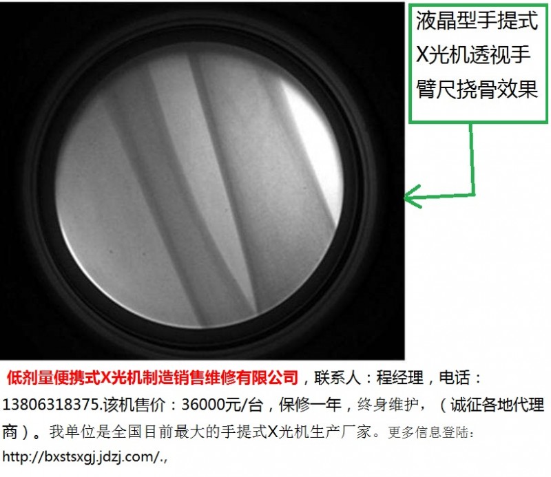 1-液晶型手提式X光机透视尺挠骨效果