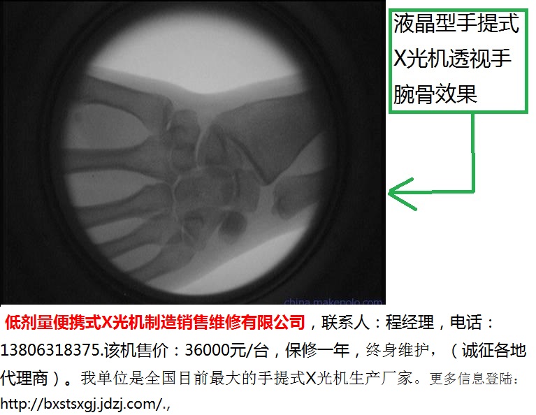 1-液晶型手提式X光机透视手脖效果