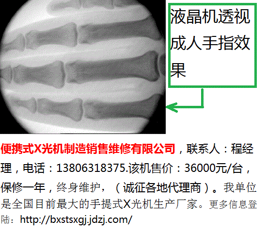 1-液晶型手提式X光机透视全手指效果