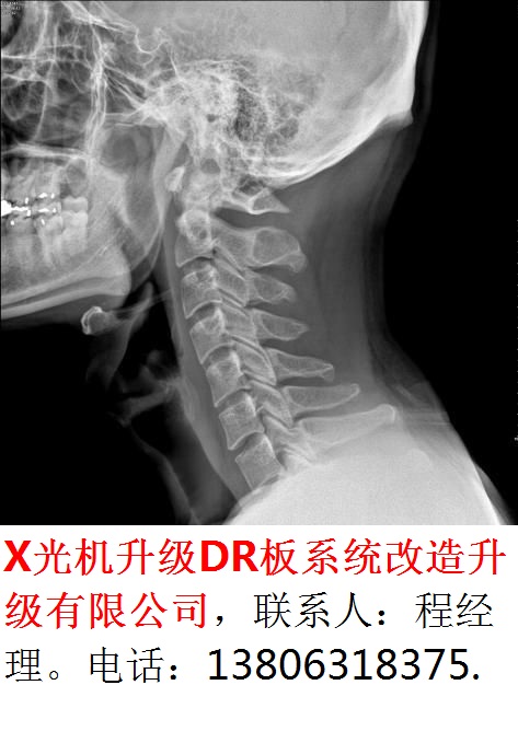 X光机数字化DR升级改造-2-1-头肩侧面成像